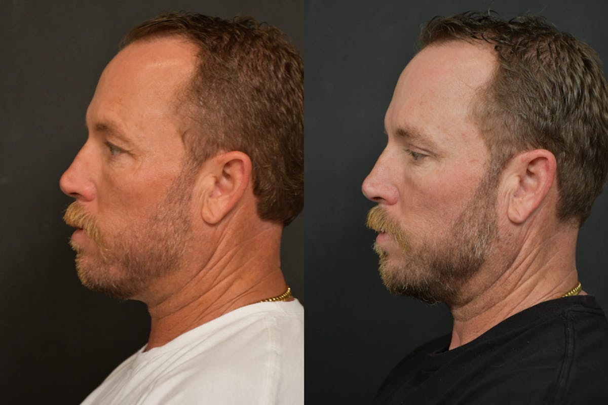 Eyelid Procedures Before & After Gallery - Patient 136558 - Image 5