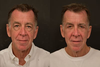Eyelid Procedures Before & After Gallery - Patient 423656 - Image 1