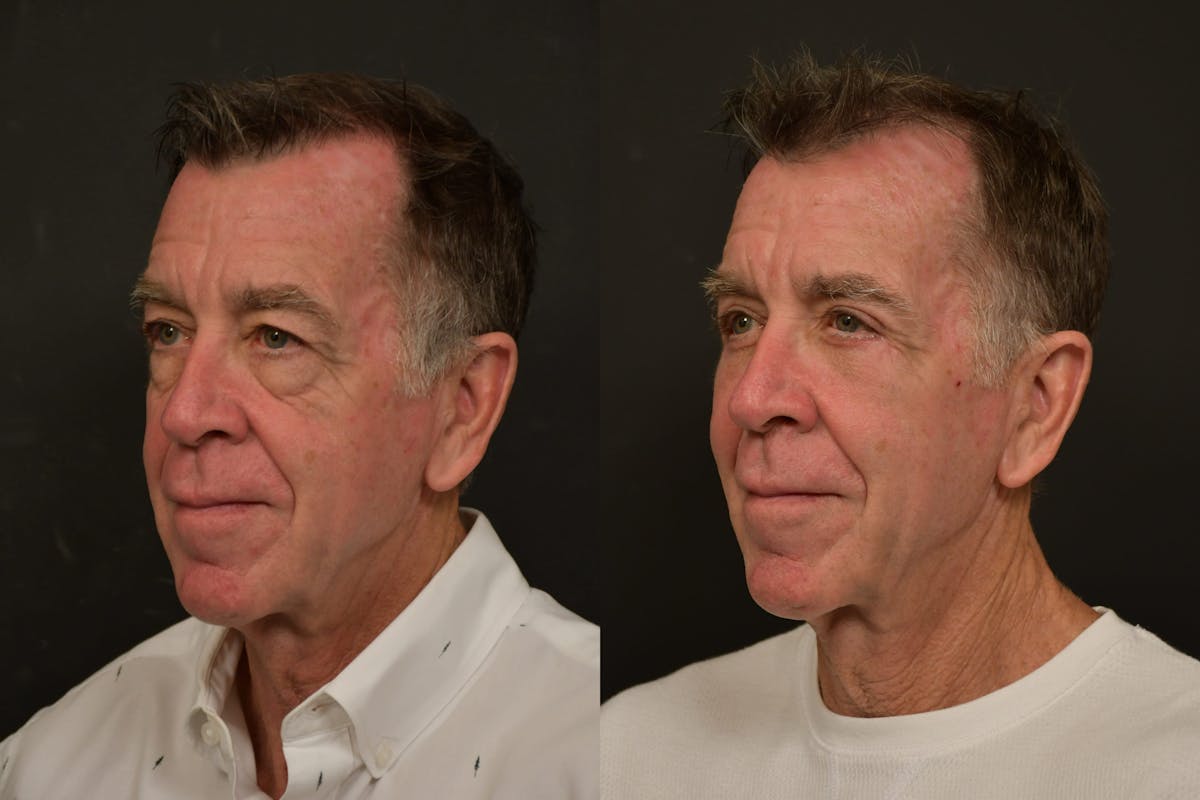 Eyelid Procedures Before & After Gallery - Patient 423656 - Image 2