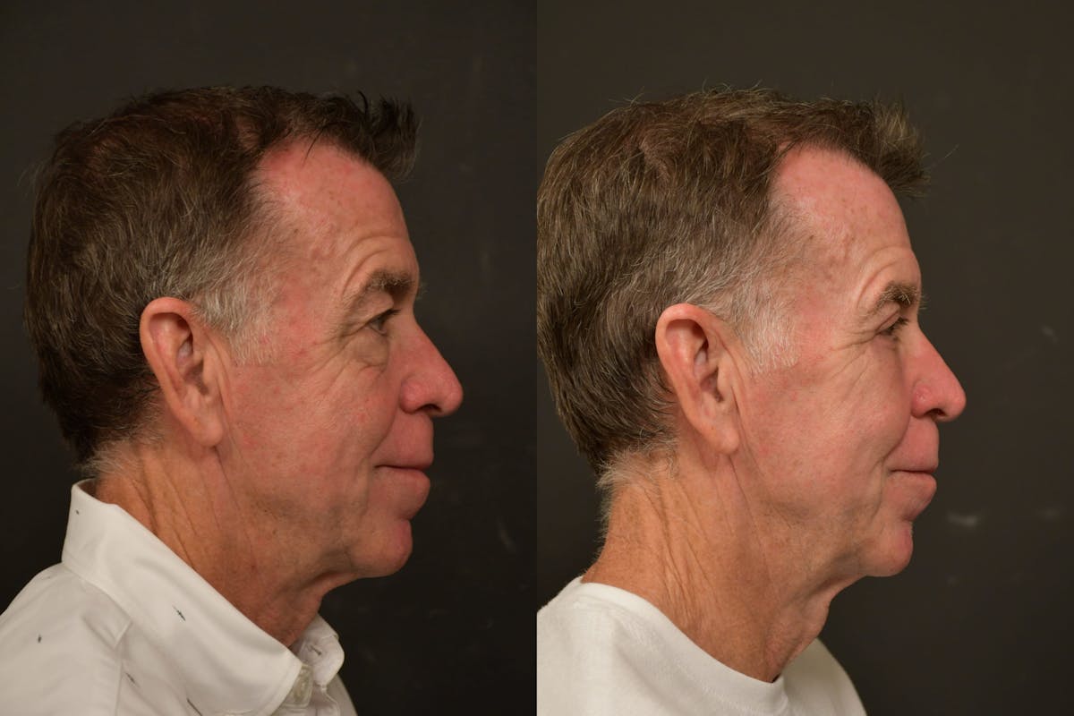 Eyelid Procedures Before & After Gallery - Patient 423656 - Image 3