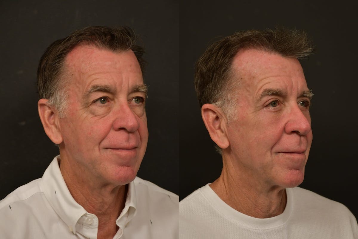Eyelid Procedures Before & After Gallery - Patient 423656 - Image 4