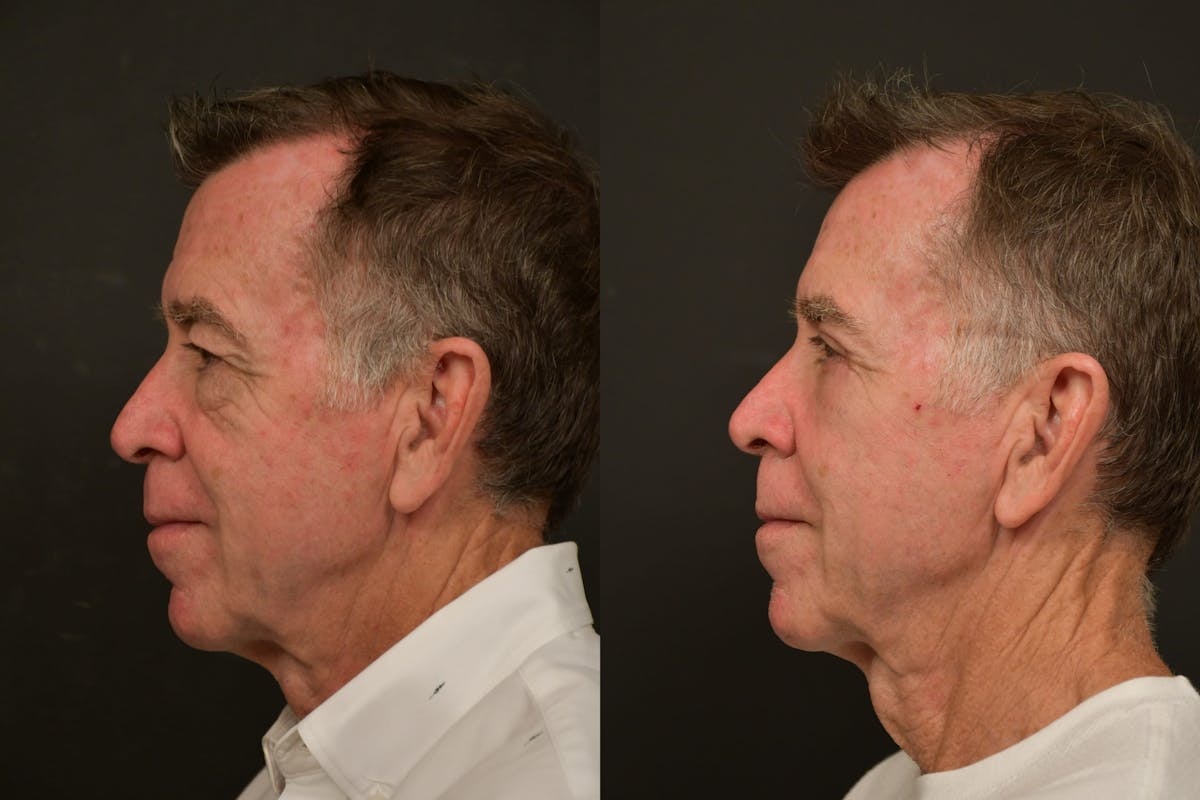 Eyelid Procedures Before & After Gallery - Patient 423656 - Image 5