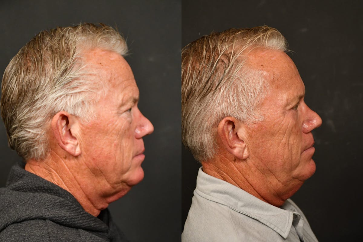 Eyelid Procedures Before & After Gallery - Patient 502940 - Image 5