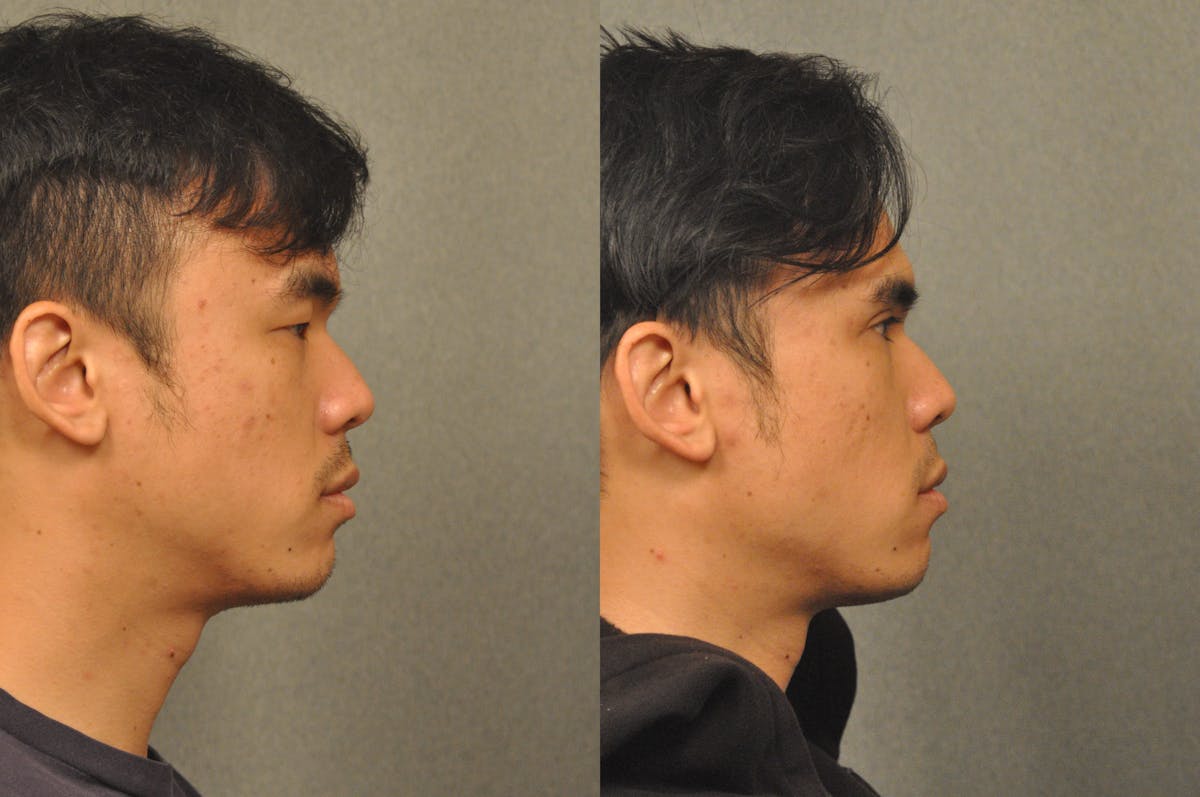 Asian Double Fold Before & After Gallery - Patient 709361 - Image 4