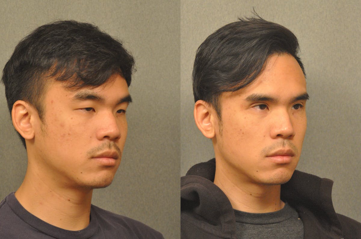 Asian Double Fold Before & After Gallery - Patient 709361 - Image 3