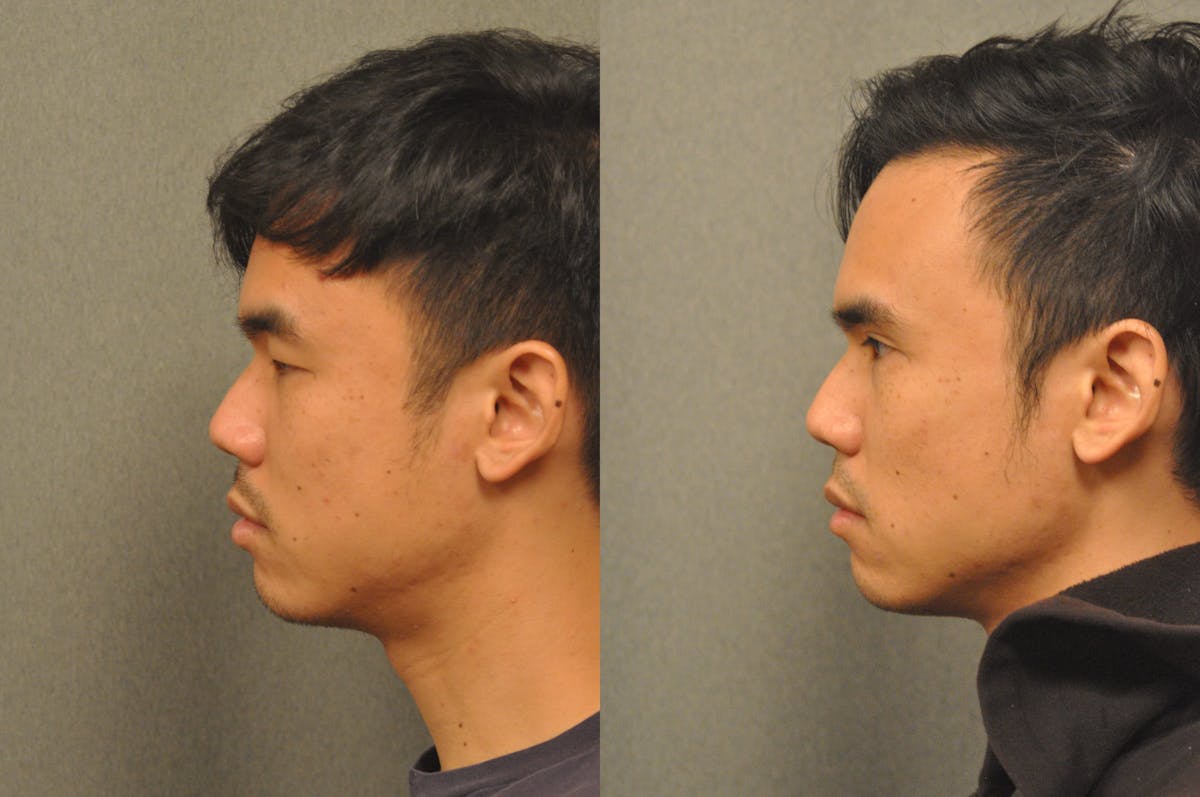 Asian Double Fold Before & After Gallery - Patient 709361 - Image 2