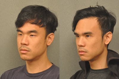 Asian Double Fold Before & After Gallery - Patient 709361 - Image 1