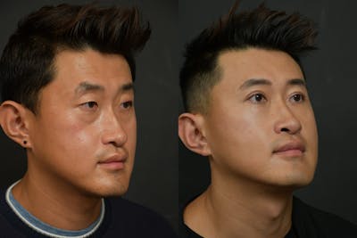 Asian Double Fold Before & After Gallery - Patient 425440 - Image 1