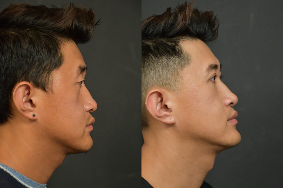 Asian Double Fold Before & After Gallery - Patient 425440 - Image 4