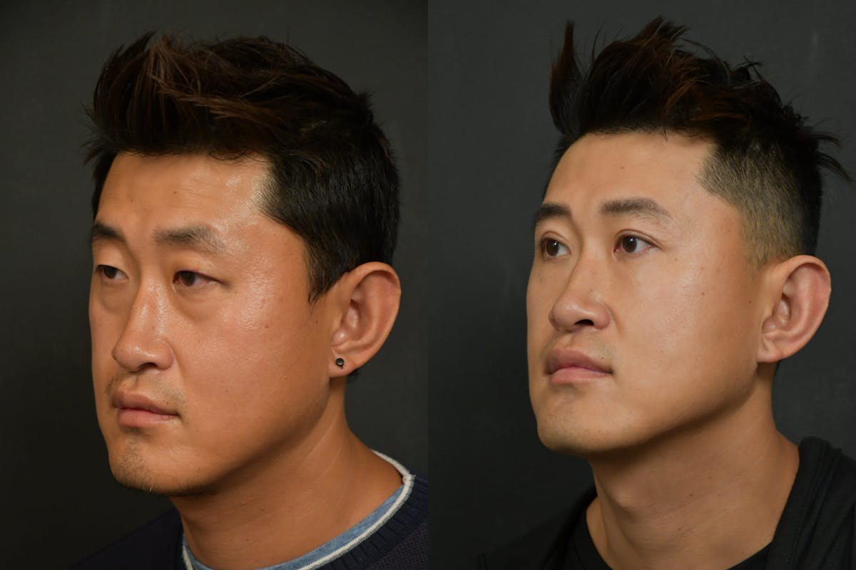 Asian Double Fold Before & After Gallery - Patient 425440 - Image 3