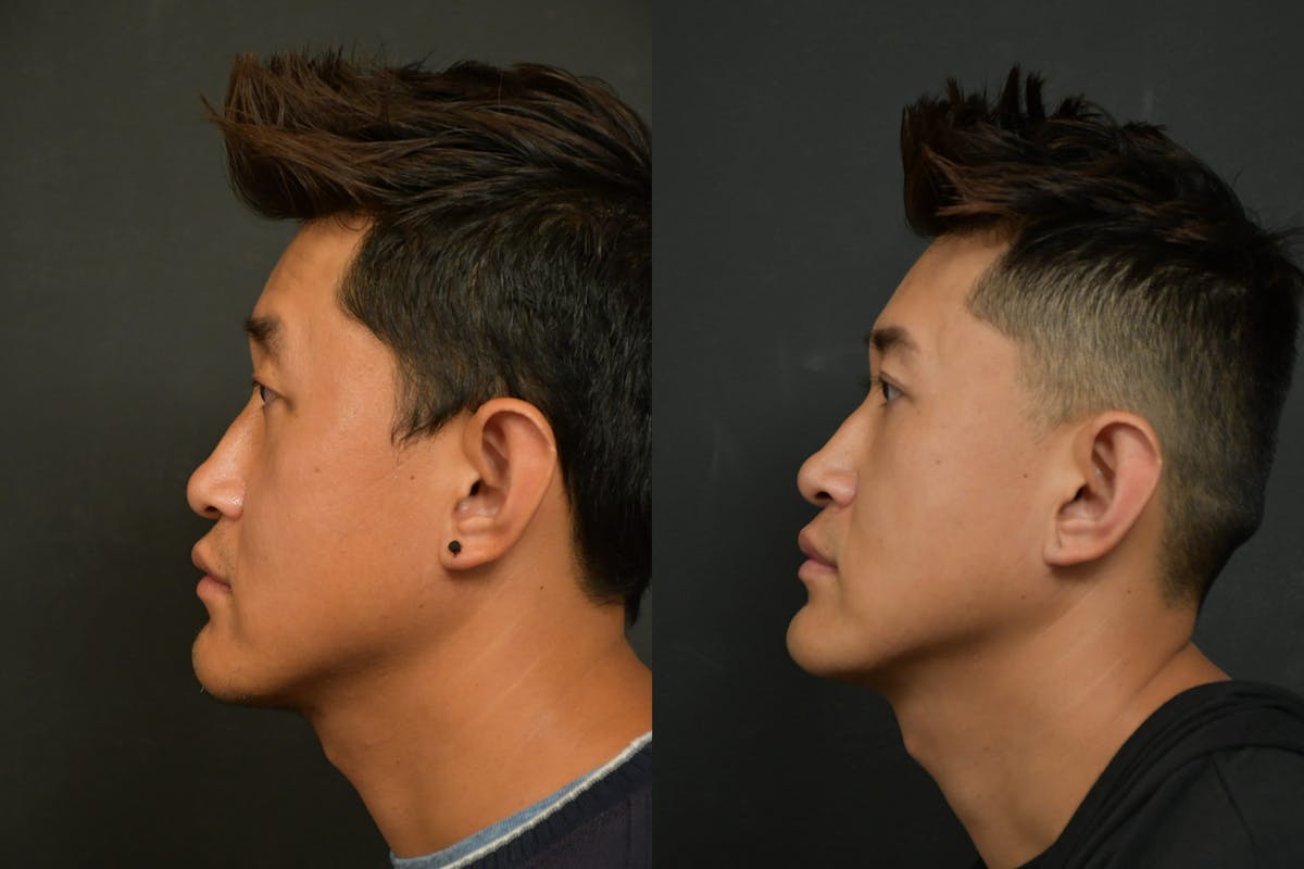 Asian Double Fold Before & After Gallery - Patient 425440 - Image 4