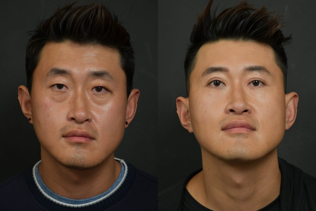 Asian Double Fold Before & After Gallery - Patient 425440 - Image 5