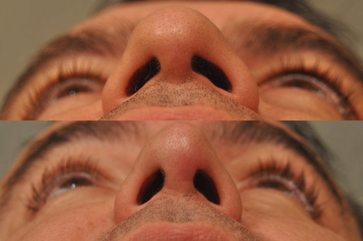 Rhinoplasty Before & After Gallery - Patient 325074 - Image 8