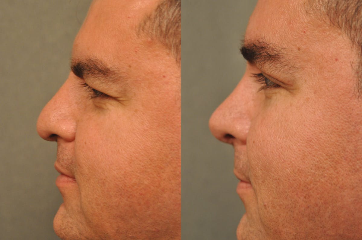 Rhinoplasty Before & After Gallery - Patient 325074 - Image 3