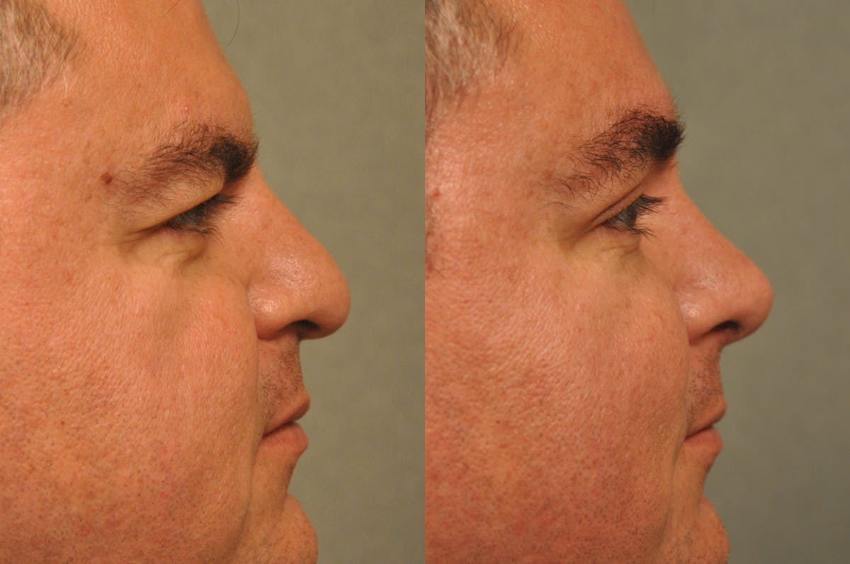 Rhinoplasty Before & After Gallery - Patient 325074 - Image 6