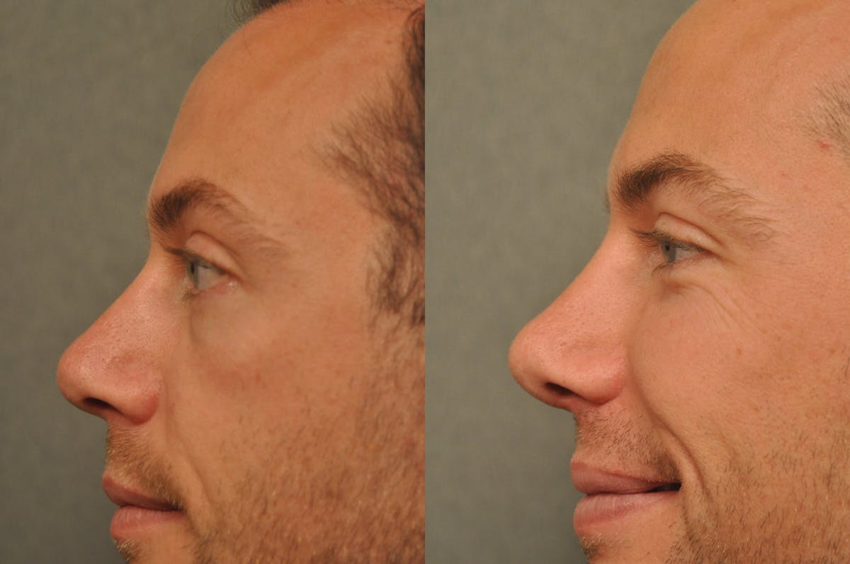 Rhinoplasty Before & After Gallery - Patient 143993 - Image 3