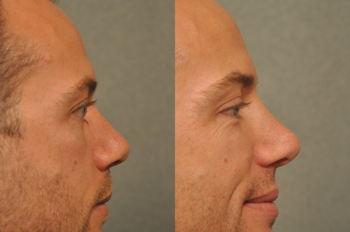 Rhinoplasty Before & After Gallery - Patient 143993 - Image 6