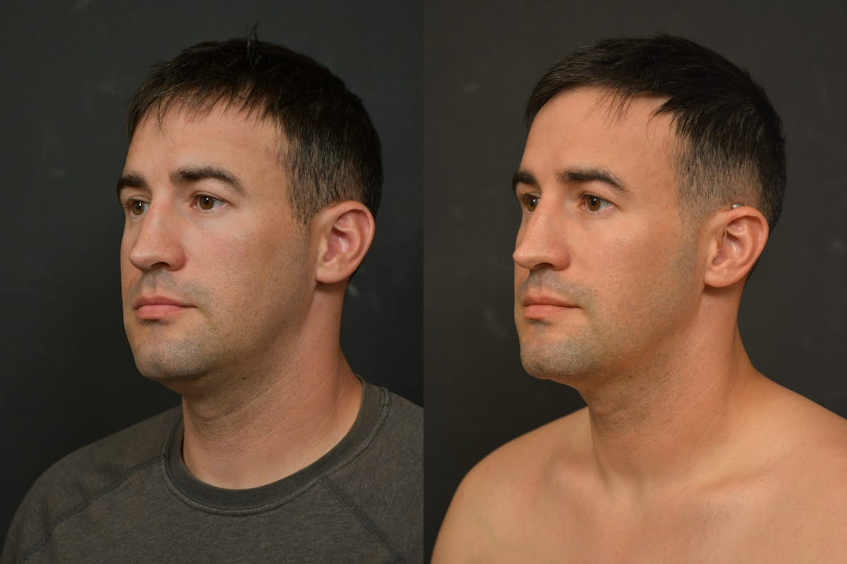 Face Liposuction Before & After Gallery - Patient 328596 - Image 2
