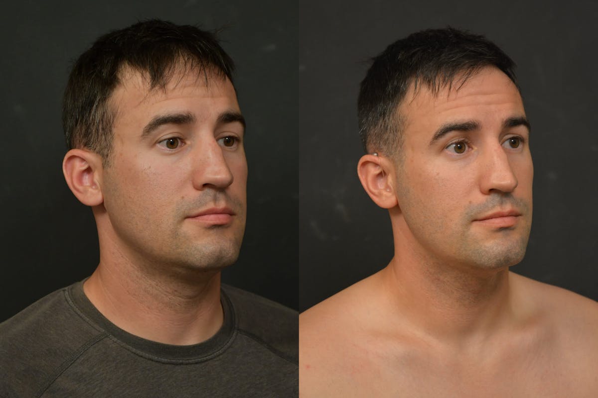 Face Liposuction Before & After Gallery - Patient 328596 - Image 4