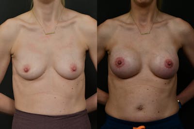 Breast Augmentation Before & After Gallery - Patient 140002 - Image 1