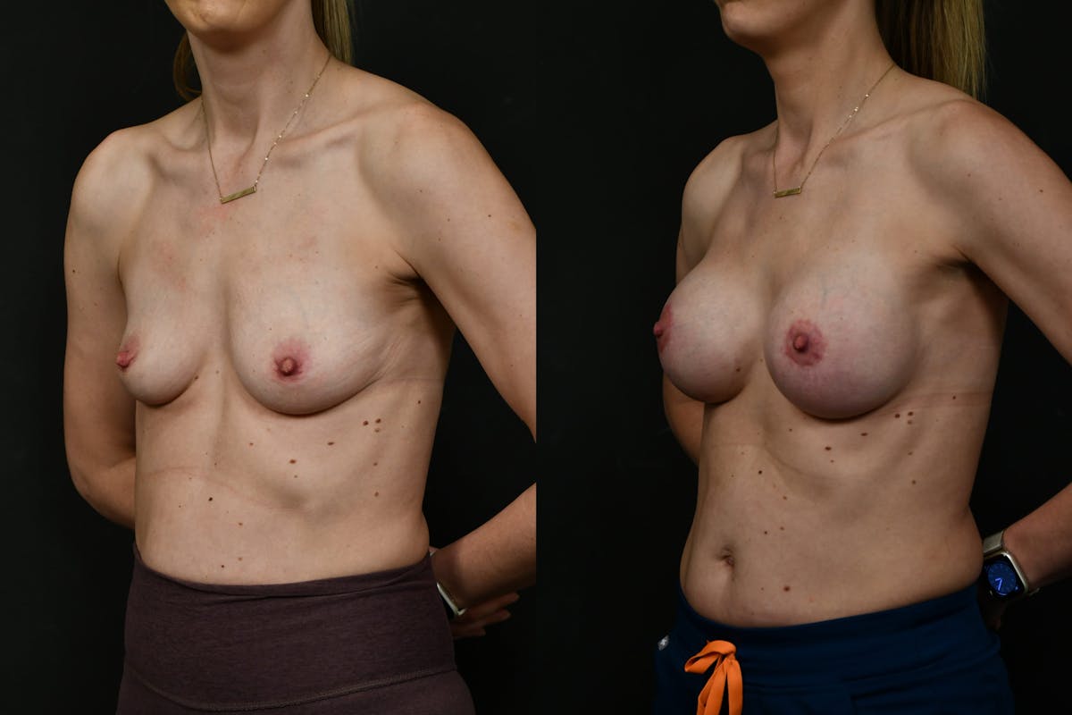 Breast Augmentation Before & After Gallery - Patient 140002 - Image 3