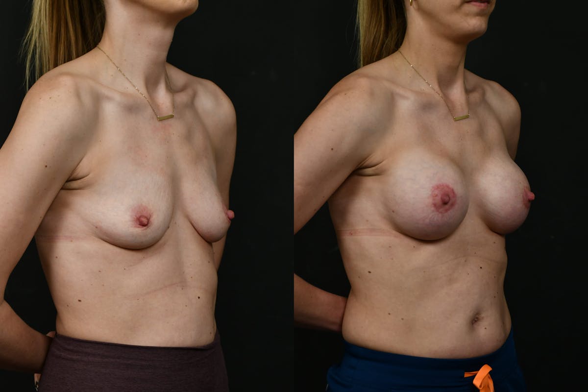 Breast Augmentation Before & After Gallery - Patient 140002 - Image 5