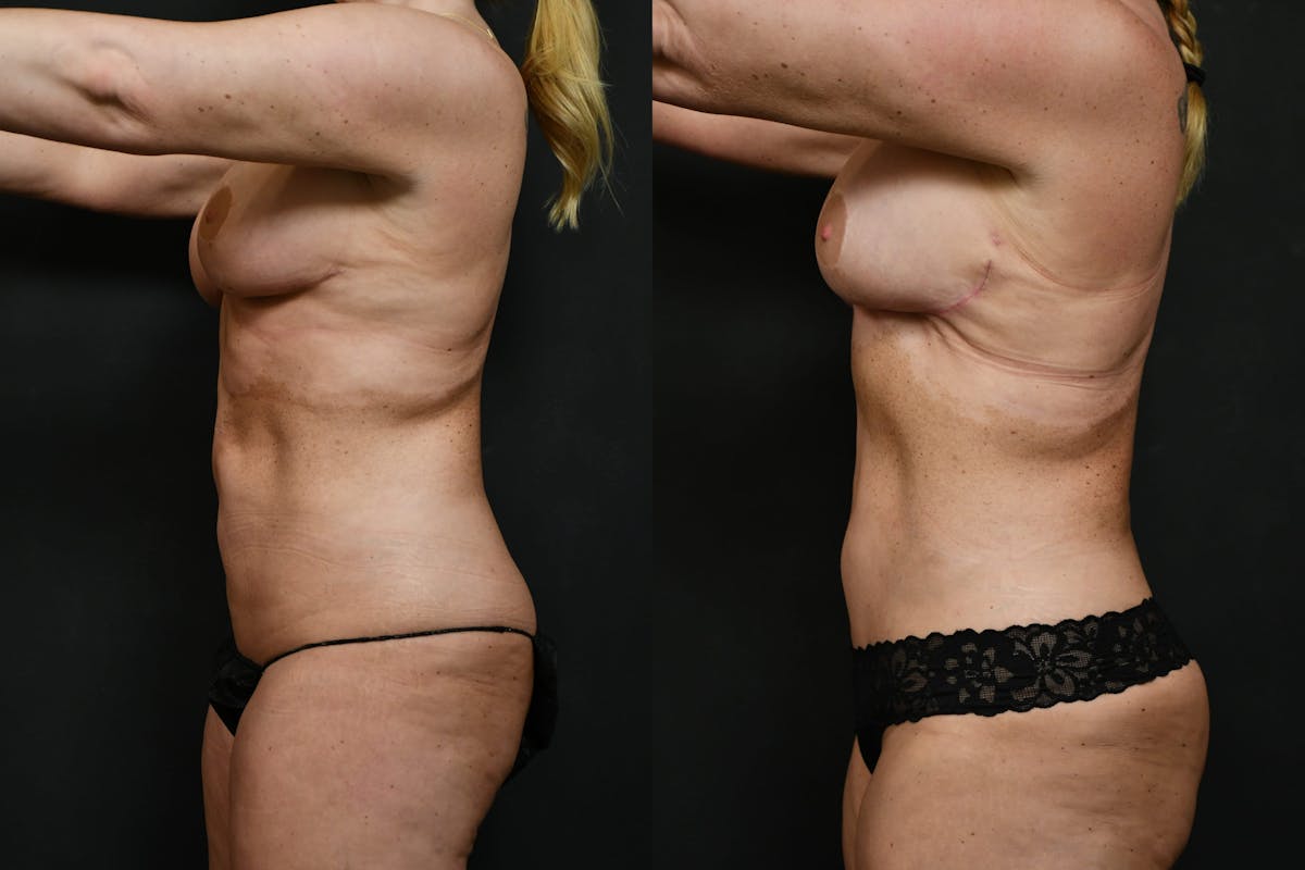 Reverse Tummy Tuck Before & After Gallery - Patient 511553 - Image 5