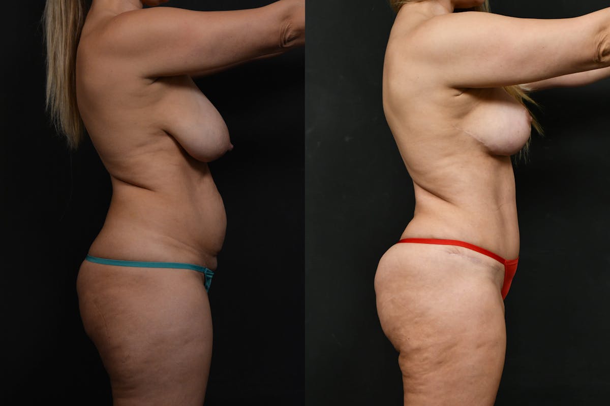 Non-Surgical Before & After Gallery - Patient 248519 - Image 3