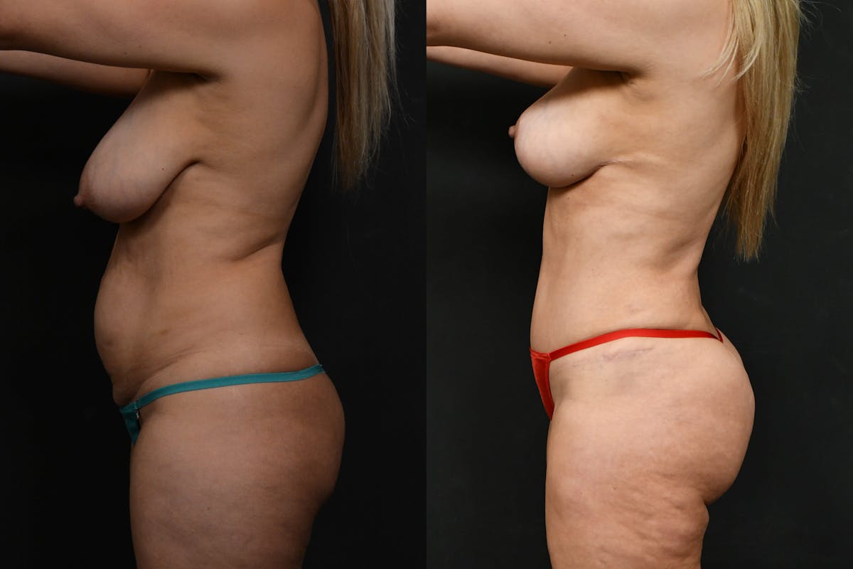 Non-Surgical Before & After Gallery - Patient 381372 - Image 5