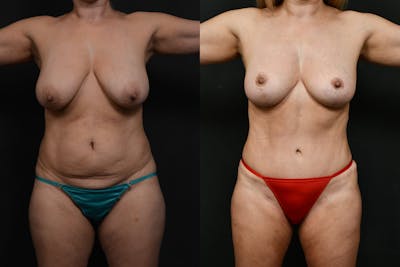 Tummy Tuck Before & After Gallery - Patient 350834 - Image 1