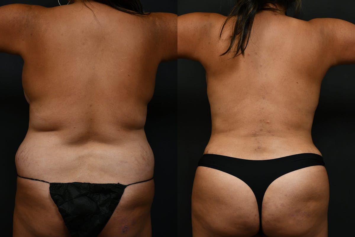 Tummy Tuck Before & After Gallery - Patient 844958 - Image 2