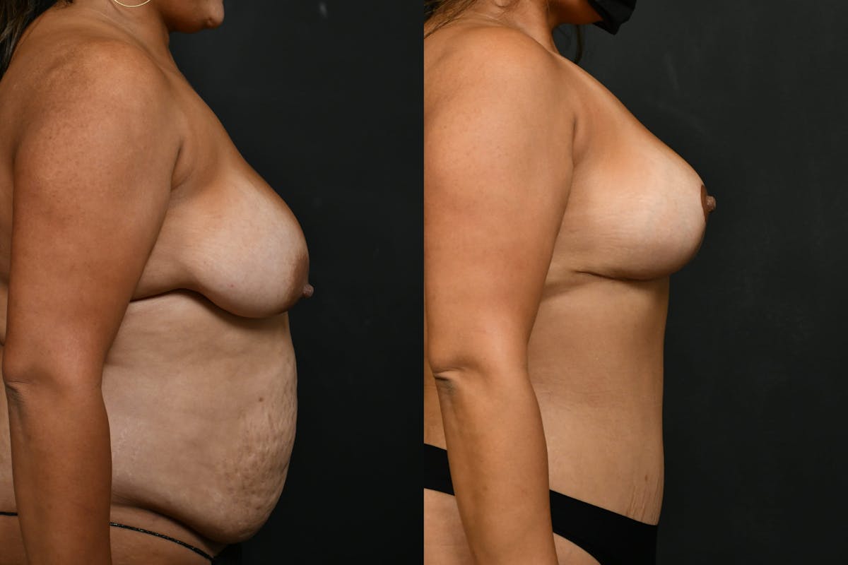 Tummy Tuck Before & After Gallery - Patient 844958 - Image 4