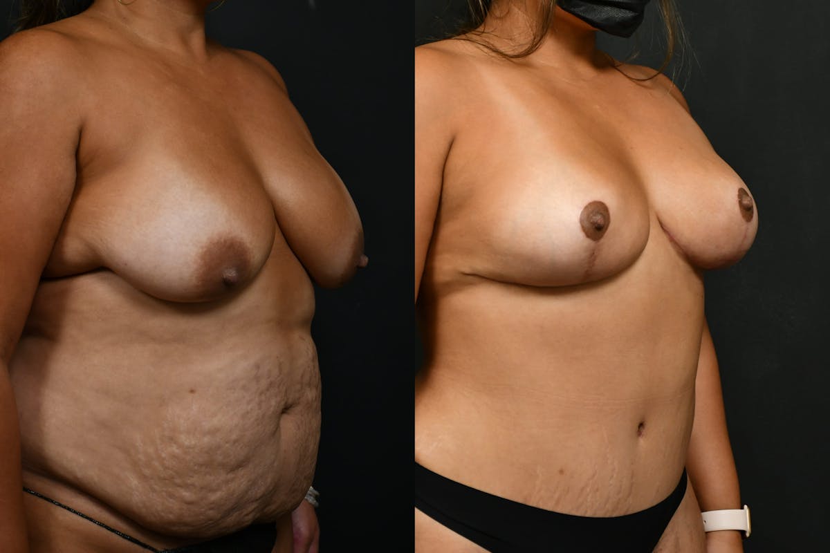 Tummy Tuck Before & After Gallery - Patient 844958 - Image 3