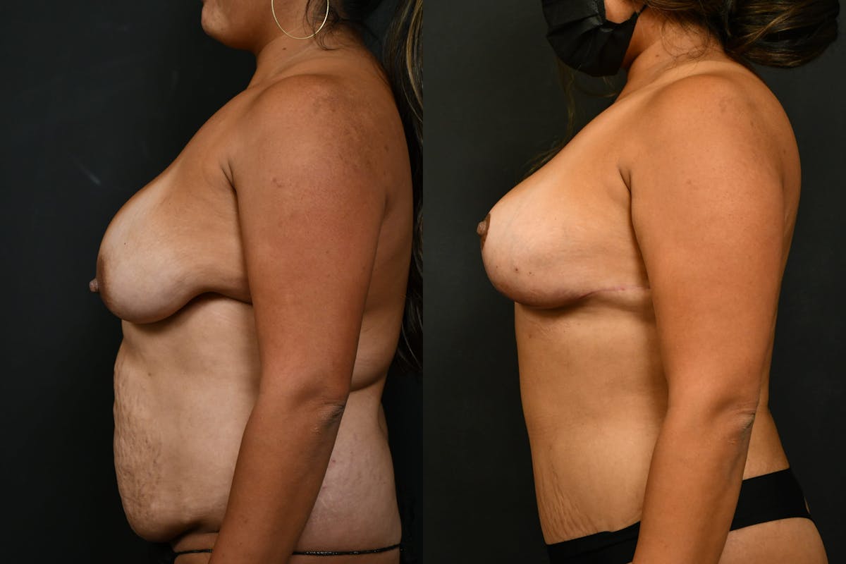 Tummy Tuck Before & After Gallery - Patient 844958 - Image 6