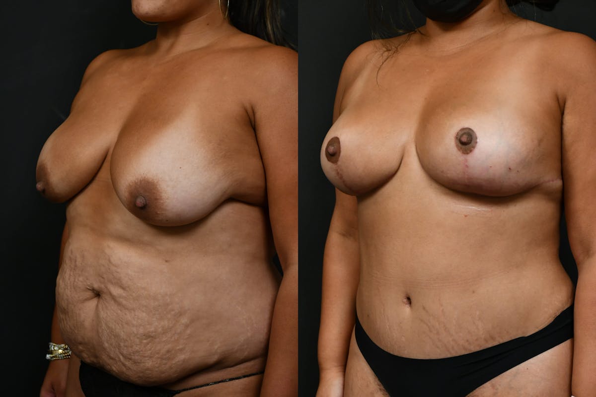 Tummy Tuck Before & After Gallery - Patient 844958 - Image 5