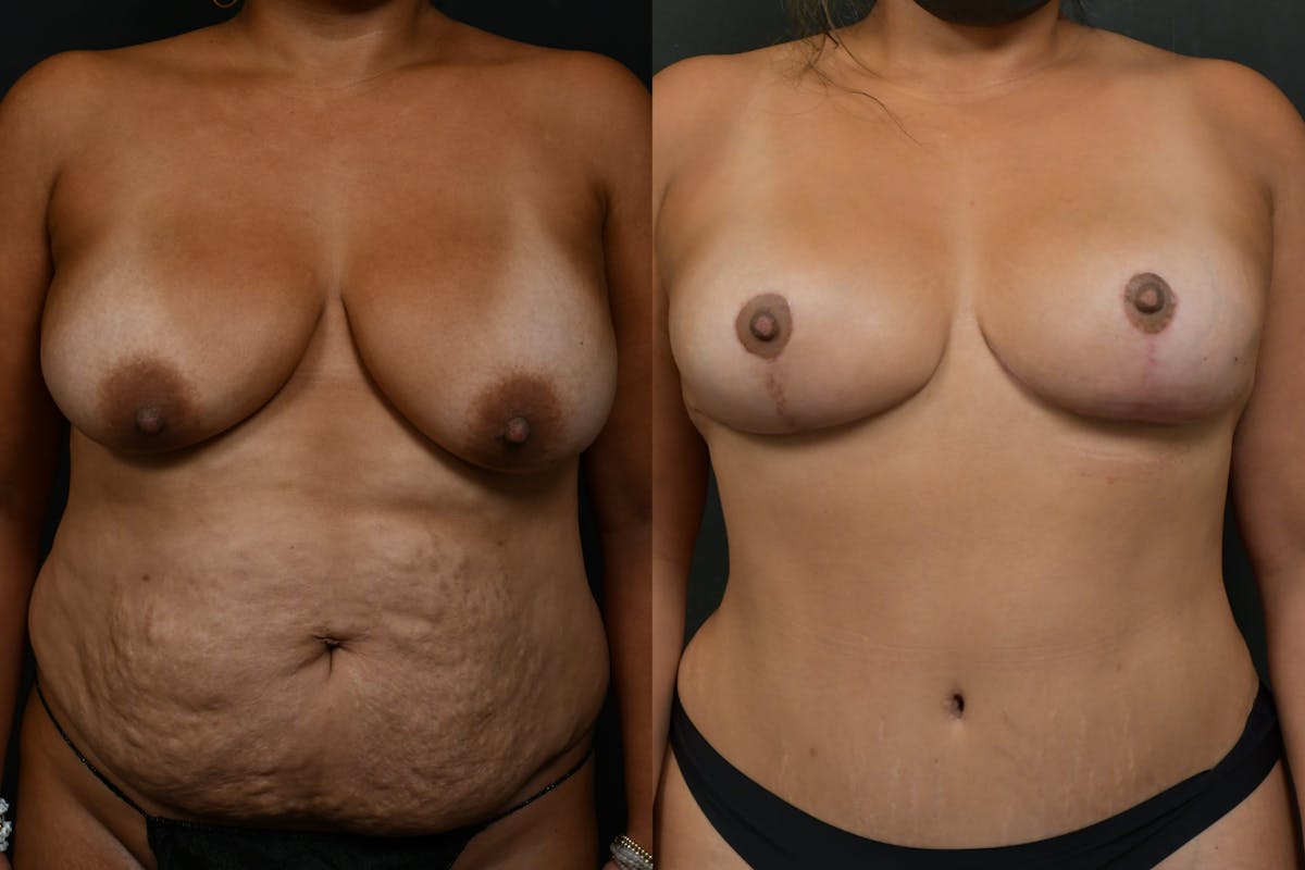 Tummy Tuck Before & After Gallery - Patient 844958 - Image 1