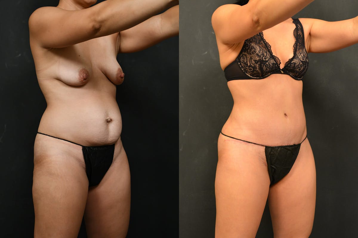 Tummy Tuck Before & After Gallery - Patient 148243 - Image 2