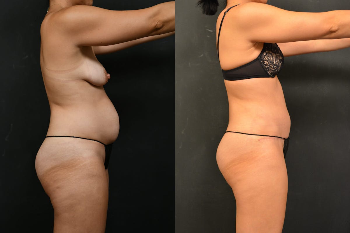 Tummy Tuck Before & After Gallery - Patient 148243 - Image 3