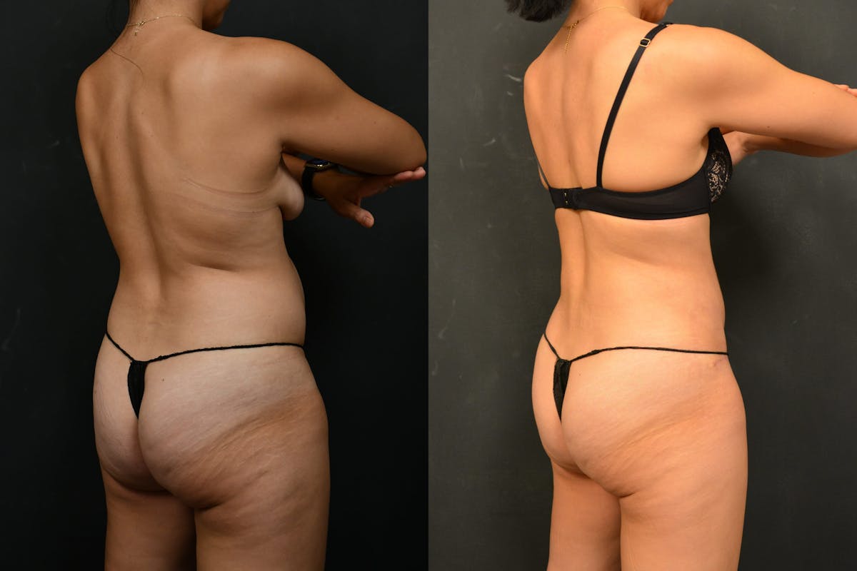 Tummy Tuck Before & After Gallery - Patient 148243 - Image 4
