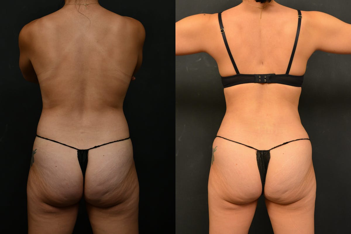 Tummy Tuck Before & After Gallery - Patient 148243 - Image 5