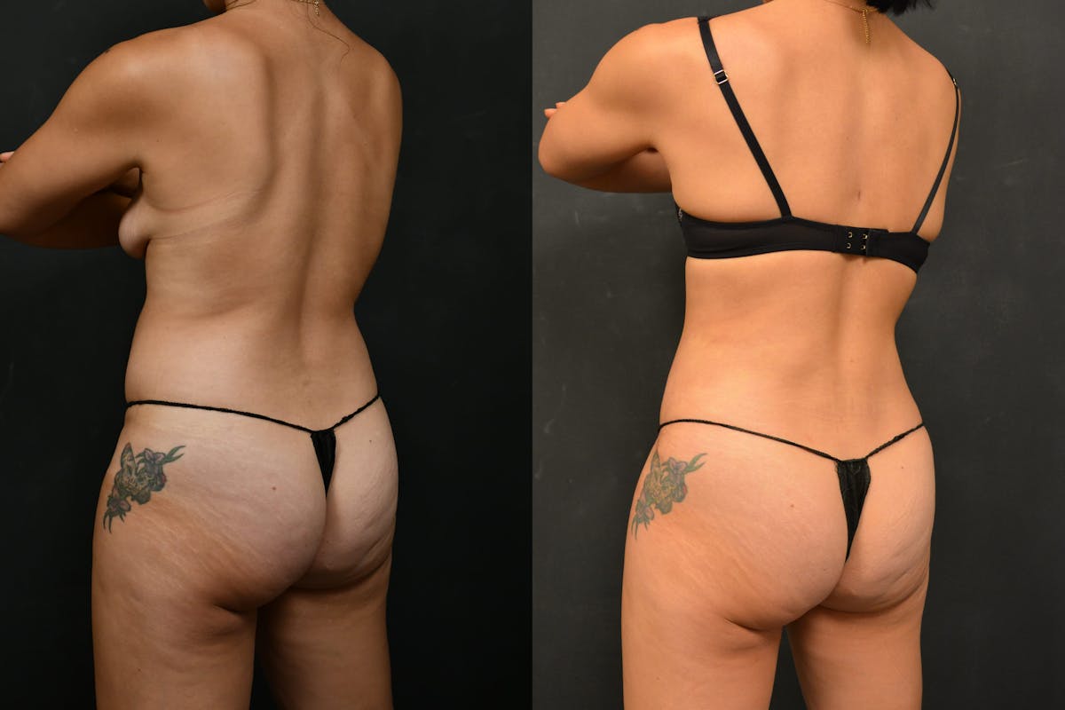 Tummy Tuck Before & After Gallery - Patient 148243 - Image 6