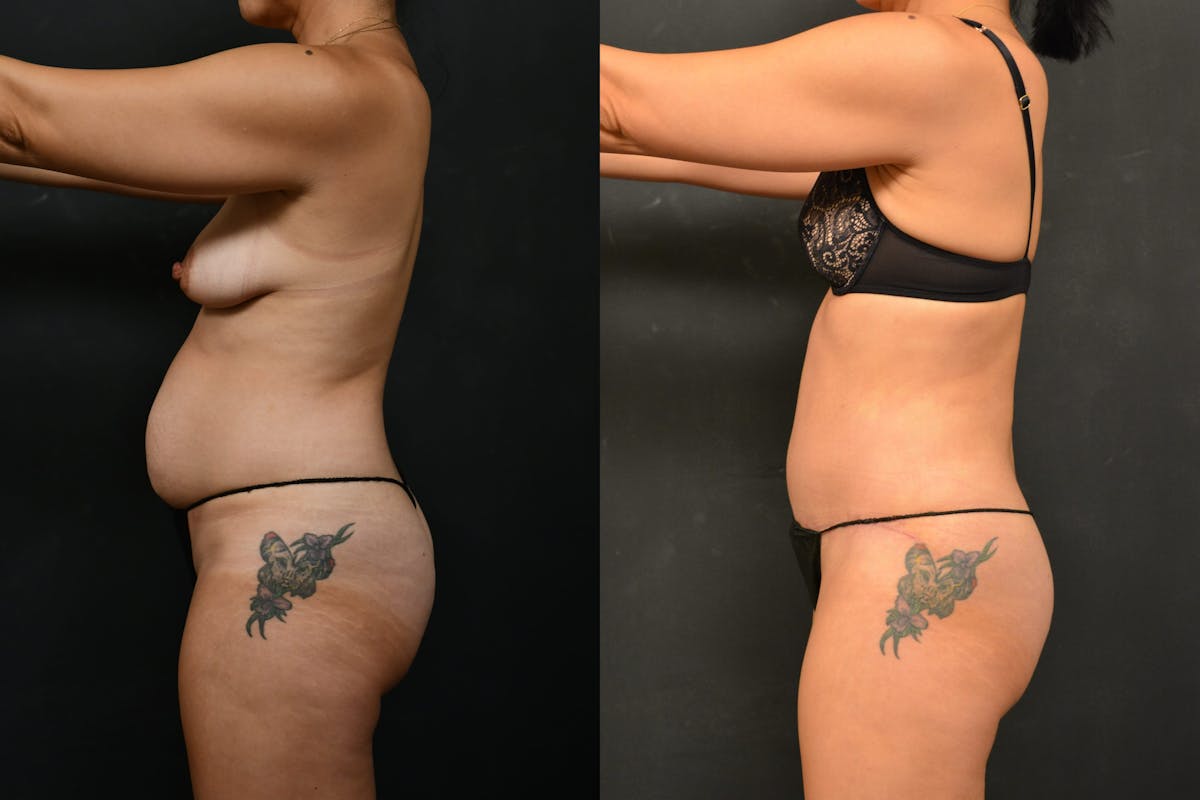 Tummy Tuck Before & After Gallery - Patient 148243 - Image 7