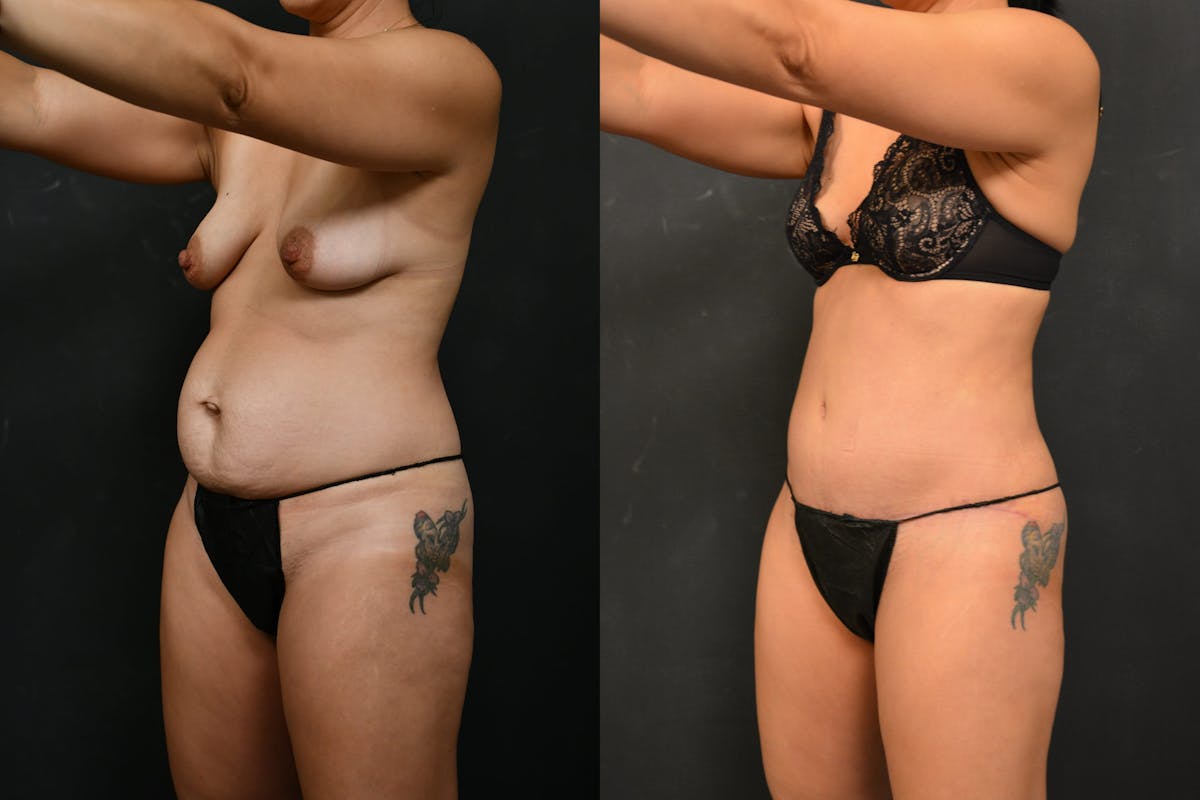 Tummy Tuck Before & After Gallery - Patient 148243 - Image 8