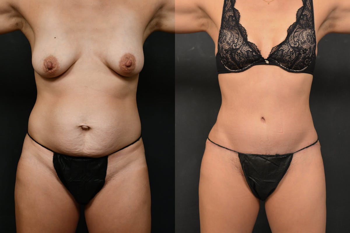 Tummy Tuck Before & After Gallery - Patient 148243 - Image 1