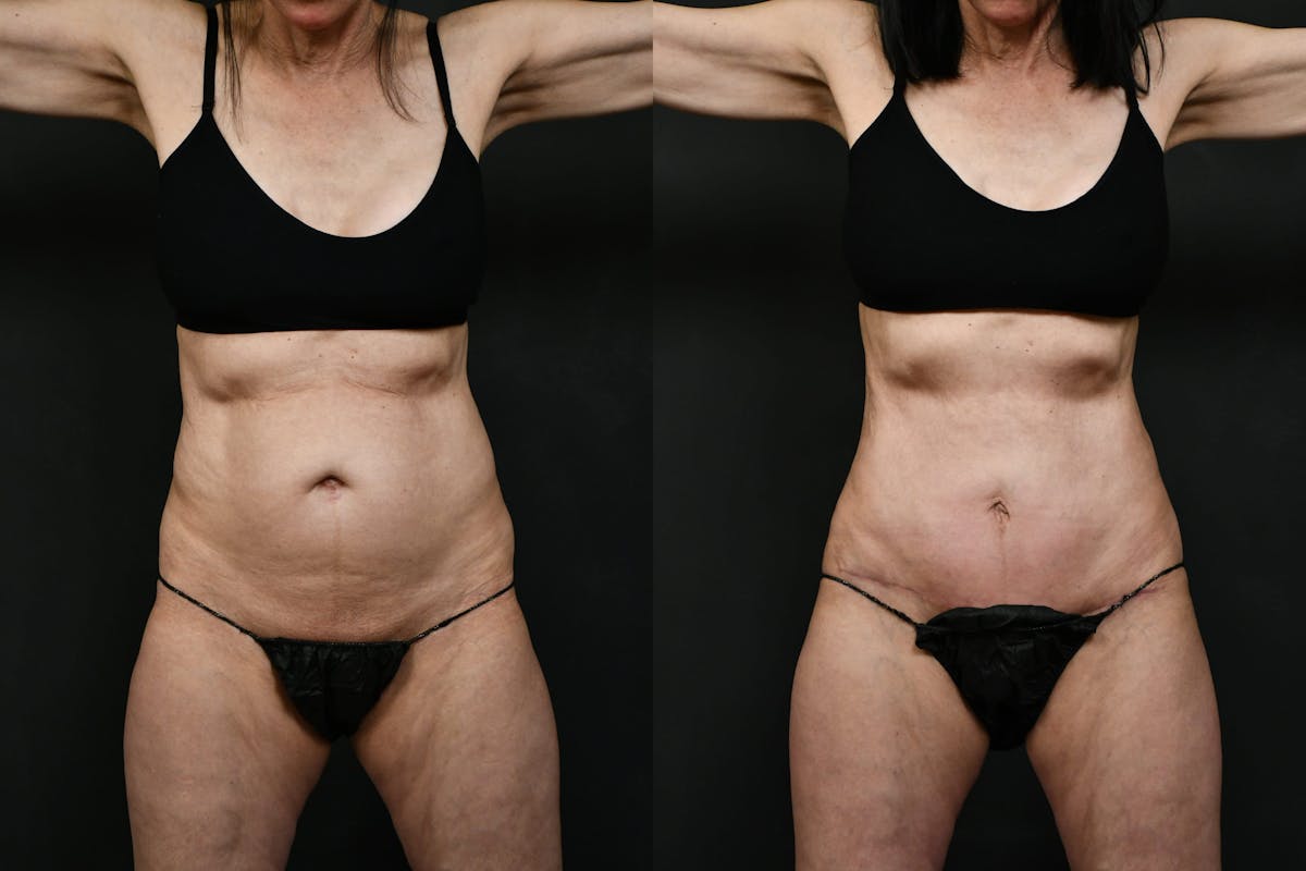 Tummy Tuck Before & After Gallery - Patient 389269 - Image 1