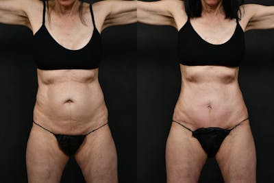 Tummy Tuck Before & After Gallery - Patient 389269 - Image 1