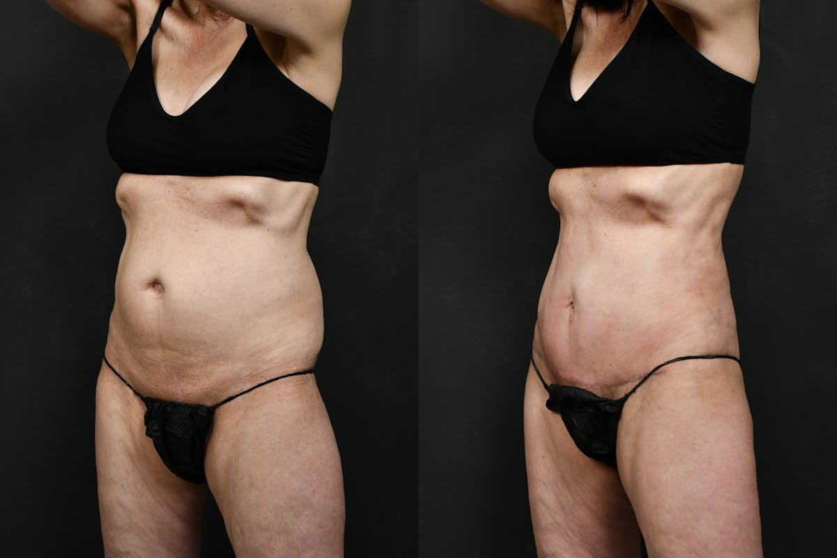 Tummy Tuck Before & After Gallery - Patient 389269 - Image 6