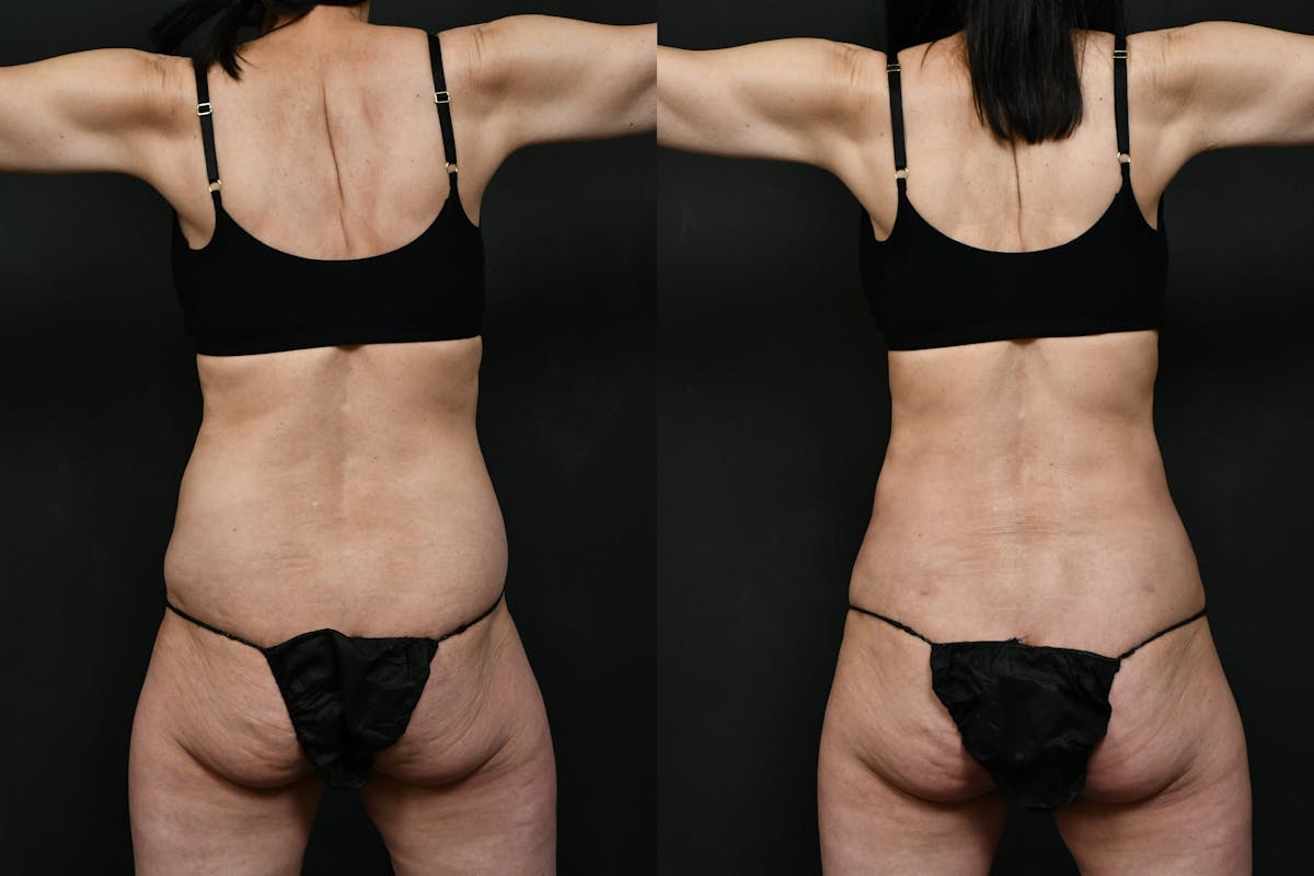 Tummy Tuck Before & After Gallery - Patient 389269 - Image 7