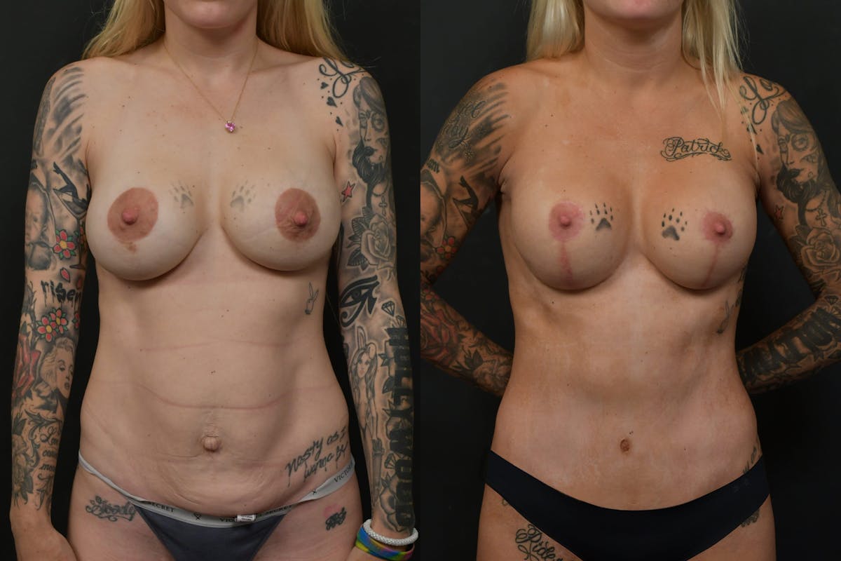 Mommy Makeover Before & After Gallery - Patient 382608 - Image 1