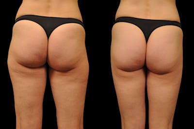 BodyTite - Thigh Before & After Gallery - Patient 299534 - Image 1